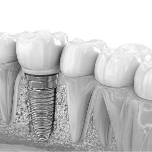 Same-Day Dental Implants at ELEMENTAL Day Surgical Center, Dubai