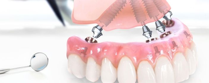 Dental implantation at ELEMENTAL Day Surgical Center, Jumeirah 1, Dubai