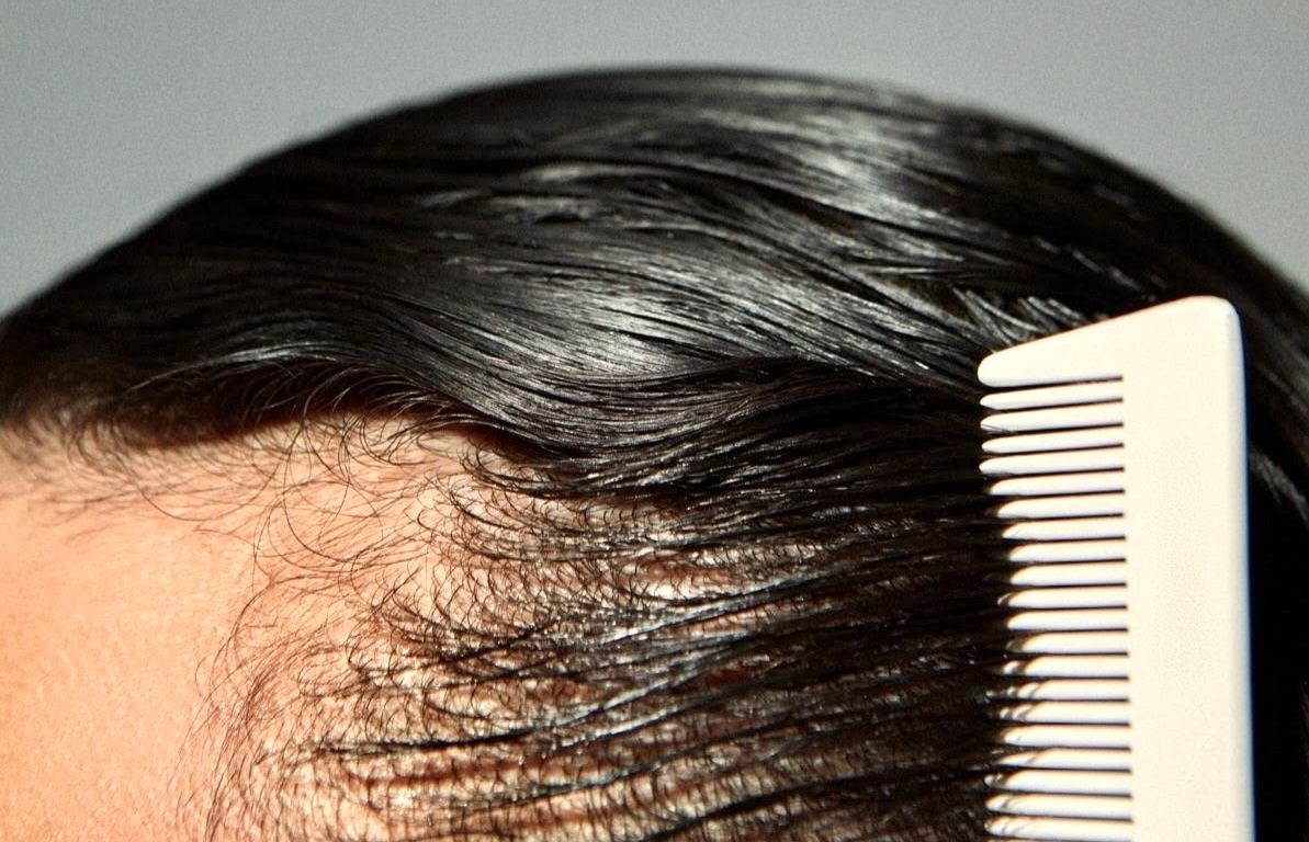 Hair Loss Treatment at ELEMENTAL Day Surgical Center, Dubai