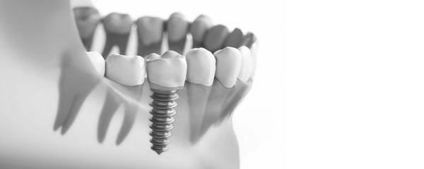 Dental Implants at ELEMENTAL Day Surgical Center, Jumeirah 1, Dubai