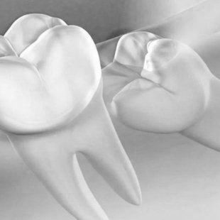 Wisdom Teeth Removal at ELEMENTAL Day Surgical Center, Dubai