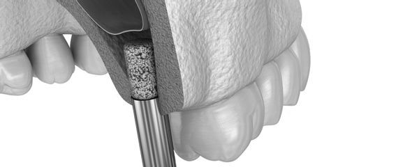 Bone Grafting and Sinus Lift at ELEMENTAL Day Surgical Center, Jumeirah 1, Dubai