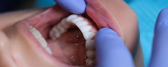Prosthetic dentistry at ELEMENTAL Day Surgical Center, Jumeirah 1, Dubai