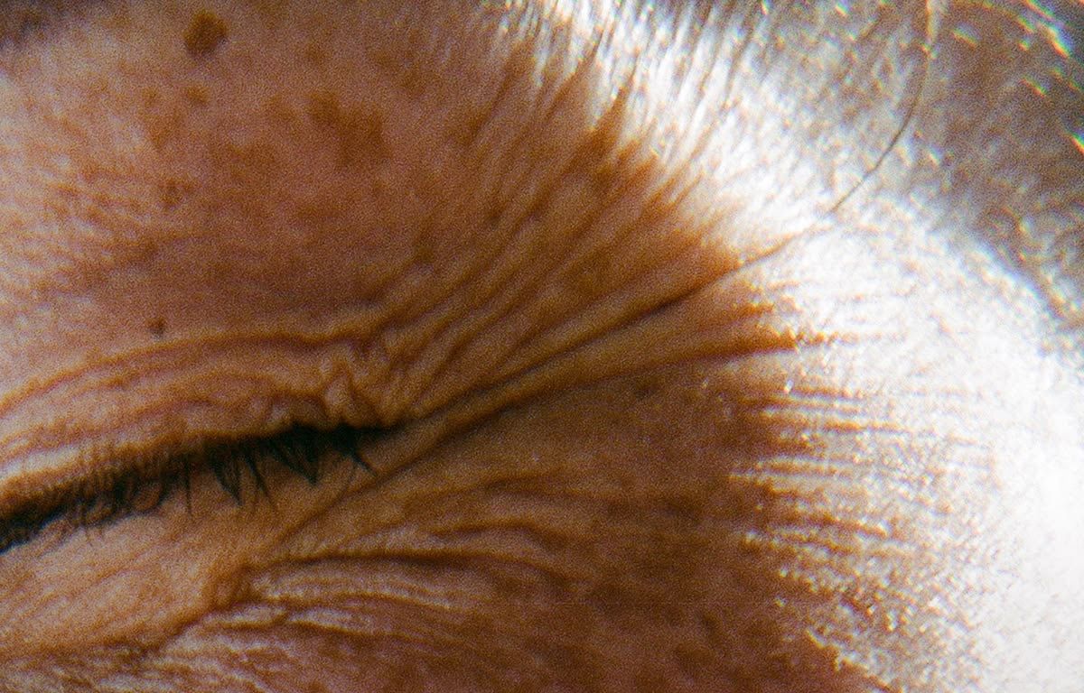 Pigmentation Treatments at ELEMENTAL Day Surgical Center, Dubai