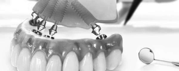All-on-4 Dental Implants at ELEMENTAL Day Surgical Center, Jumeirah 1, Dubai