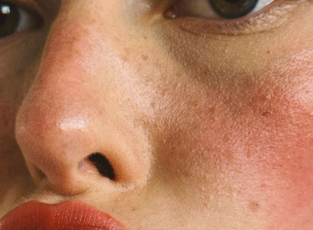 Rosacea Treatment at ELEMENTAL Day Surgical Center, Dubai