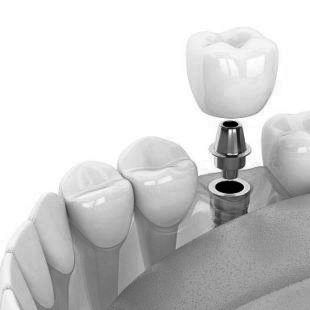 Dental Implants at ELEMENTAL Day Surgical Center, Dubai