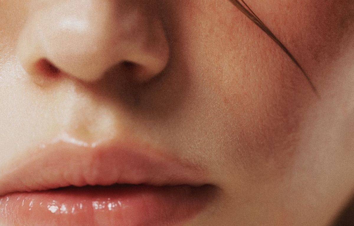 Broken capillaries on cheeks before laser treatment