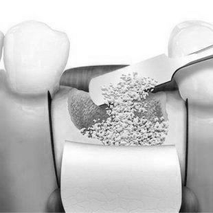 Bone Grafting and Sinus Lift at ELEMENTAL Day Surgical Center, Dubai