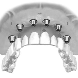 All-on-6 Dental Implants at ELEMENTAL Day Surgical Center, Dubai