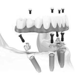 All-on-4 Dental Implants at ELEMENTAL Day Surgical Center, Dubai