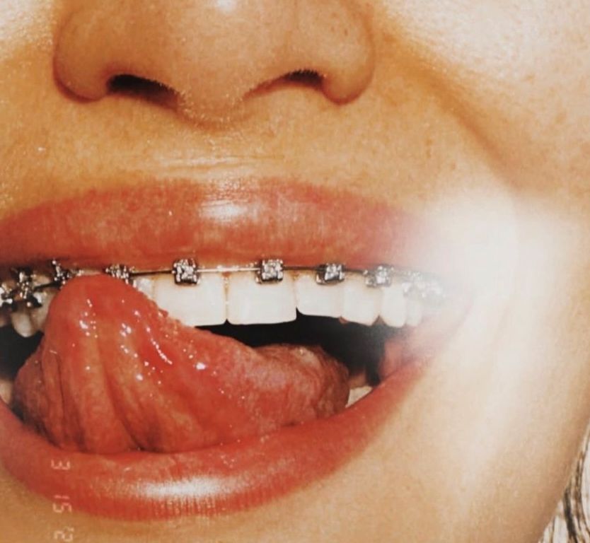 Dental Braces at ELEMENTAL Day Surgical Center, Dubai